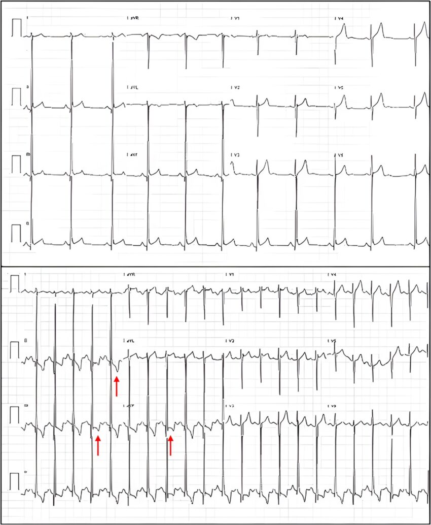 Temuan tak terduga pada atlet dayung remaja dengan angina pectoris. Laporan kasus